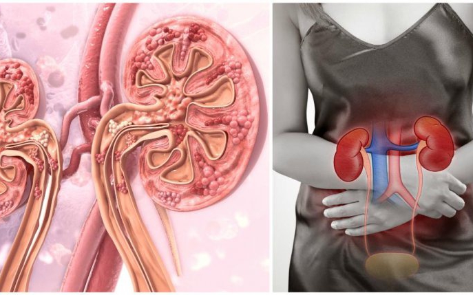 Blocajul renal: 10 semne pe care să nu le ignori