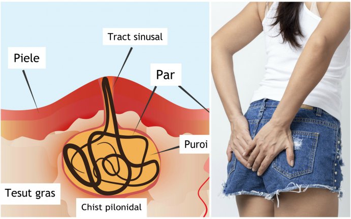 Chist pilonidal: ce este și pe cine afectează