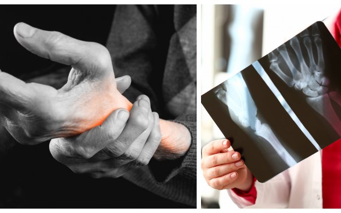 Cum apare artroza mâinilor, ce este și cum se tratează