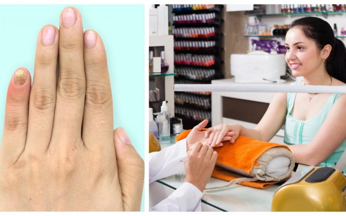 „Mucegai” pe unghie: de ce apare și ce tratament trebuie să urmezi