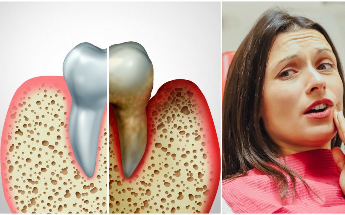 Parodontoza se ia? Află totul despre această boală și dacă poate fi contagioasă