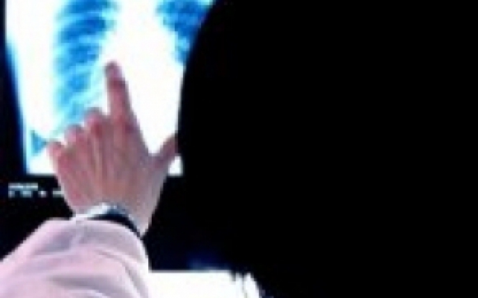 Limfomul Hodgkin - Simptome, diagnostic si tratament