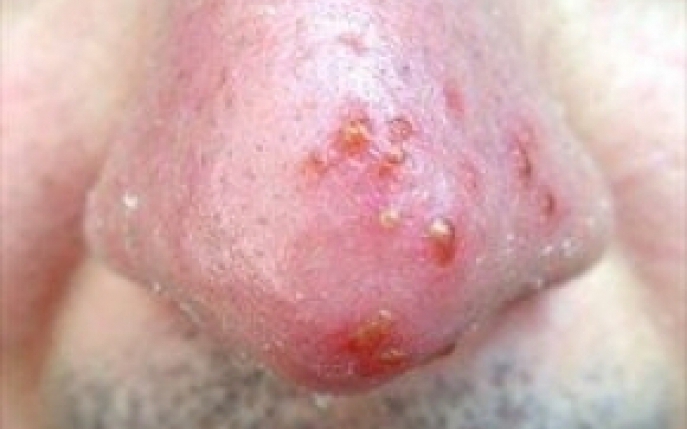 Rozaceea - simptome, diagnostic si tratament