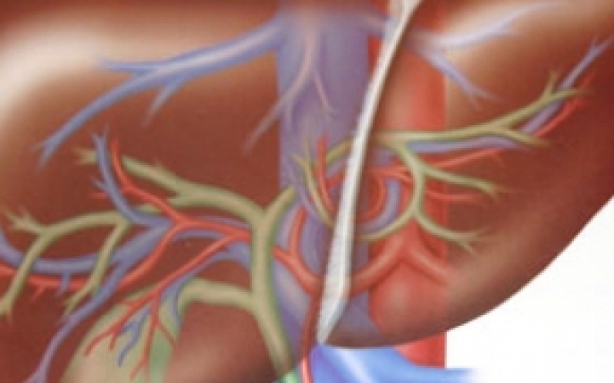 Cancerul hepatic - simptome, diagnostic si tratament