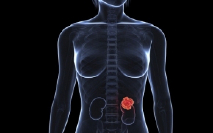 Cancerul renal - simptome, diagnostic, tratament