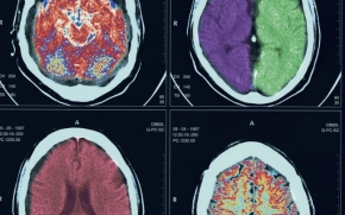 Abcesul epidural - simptome, diagnostic si tratament