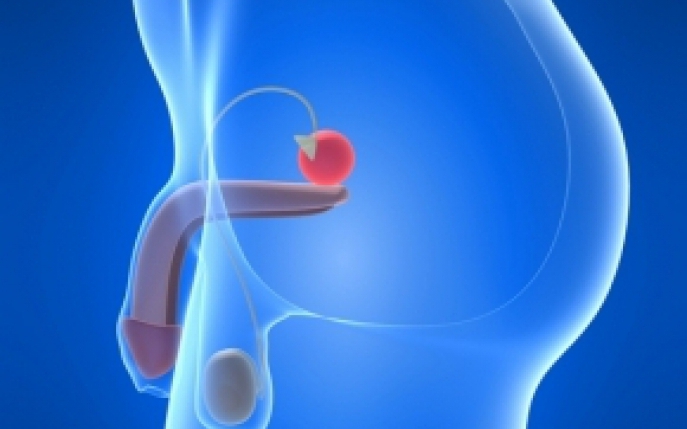 Varicocelul - simptome, diagnostic, tratament