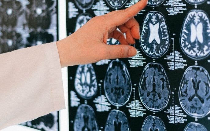 Premieră mondială: O femeie paralizată a reușit să comunice cu ajutorul unui avatar digital