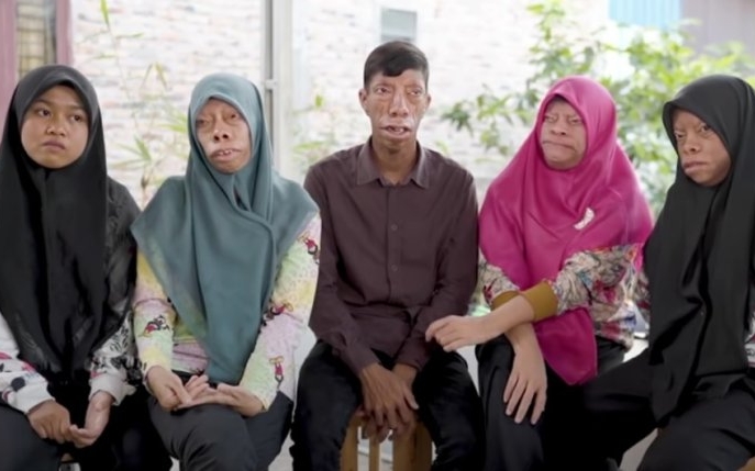 Faceți cunoștință cu familia "Șopârlă". Nu, nu au un nume de amuzant, ci suferă de o malformație care le modifică fizionomia