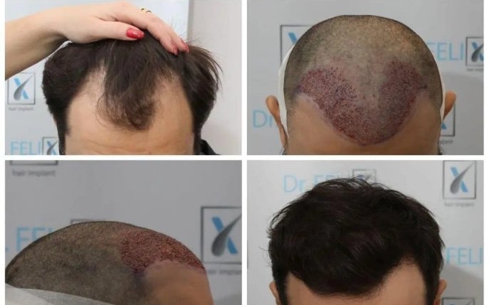 Transplantul de păr: cât costă și cât durează o astfel de procedură?