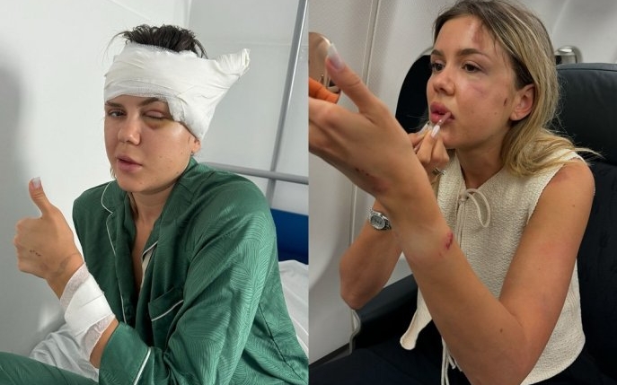 Cum se mai simte Emily Burghelea, la trei săptămâni după accidentul grav în care a fost implicată. „Am rămas cu o gaură în cap"