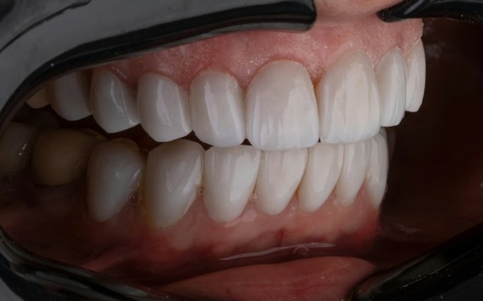 Cum să îți menții sănătatea gingiilor pentru a preveni parodontoza