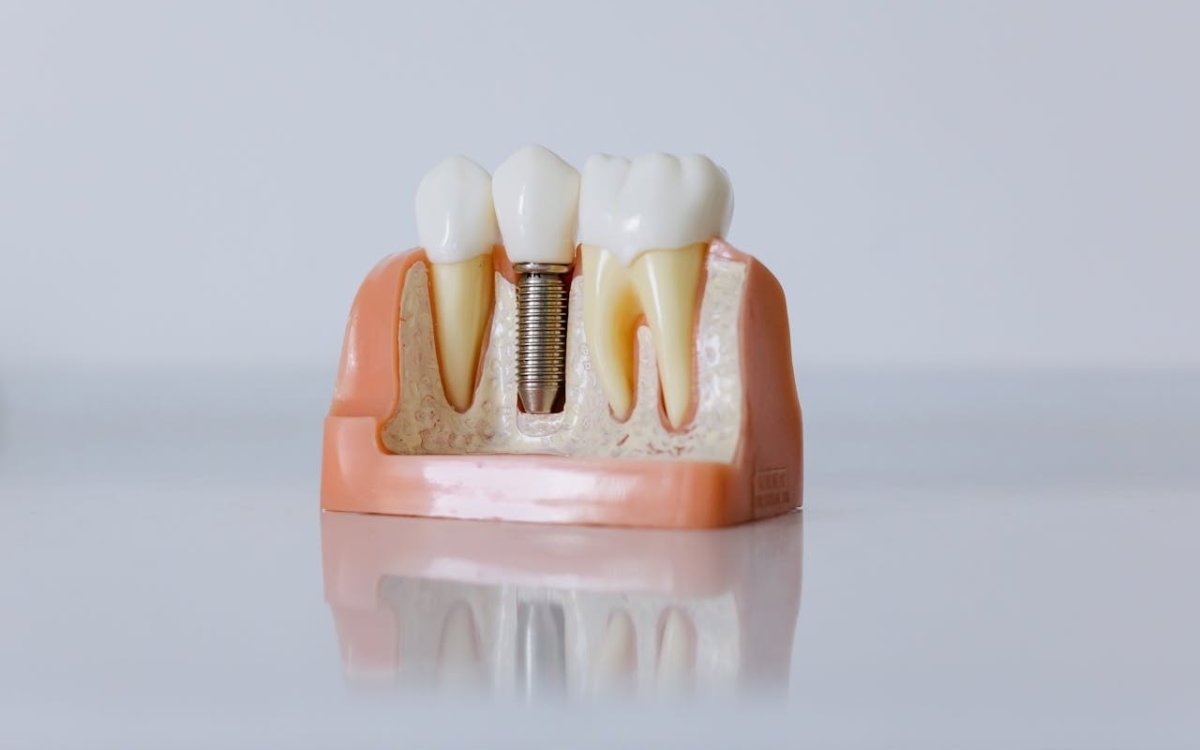 Cum știi că ai nevoie de un implant dentar
