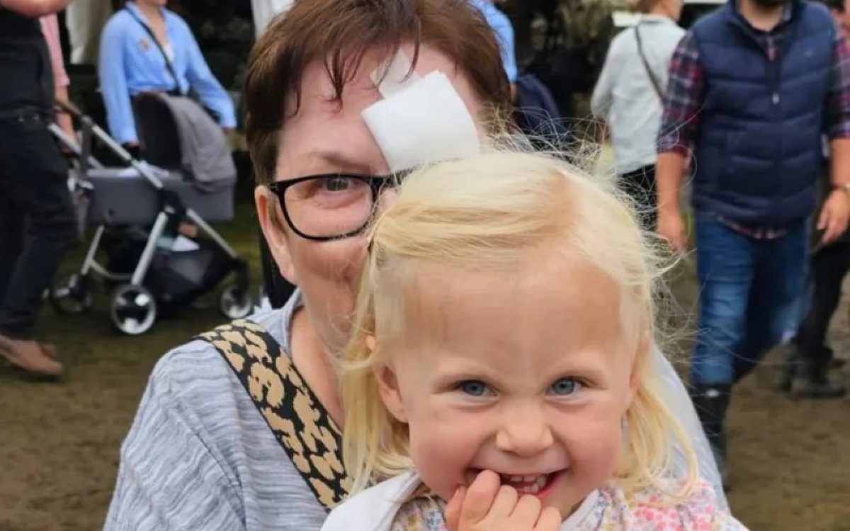 A crezut că are o simplă alergie, dar a fost la un pas de moarte! O femeie a rămas fără un ochi și cu o gaură în față din cauza unei forme de cancer extrem de rară