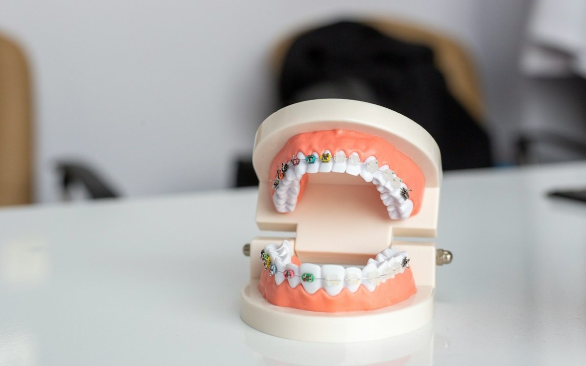Cum să te adaptezi la viața cu aparat dentar: Sfaturi practice și recomandări