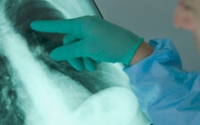 Emfizemul pulmonar - simptome, diagnostic si tratament