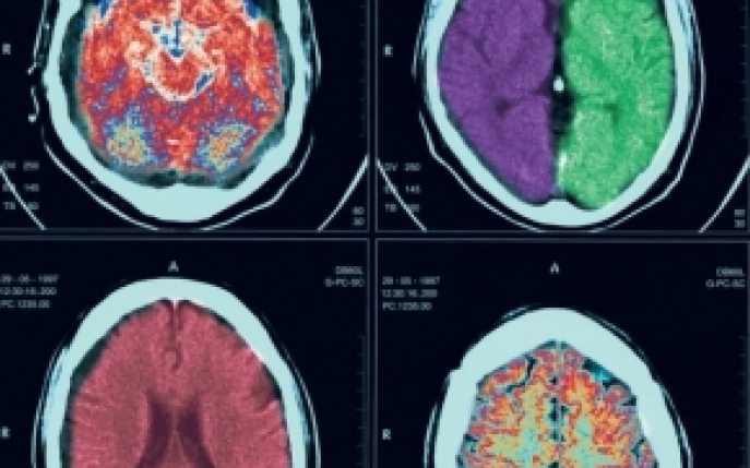 Craniosinostoza - simptome, diagnostic, tratament