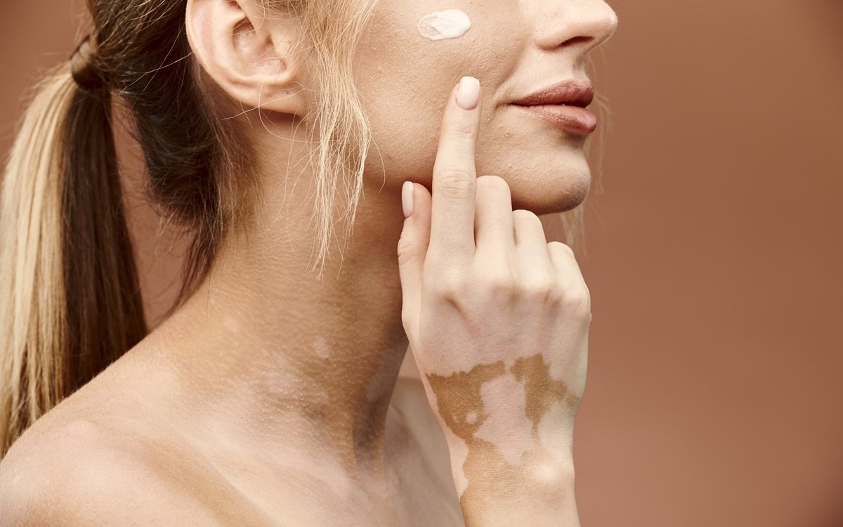 Vitiligo: mituri și adevăruri