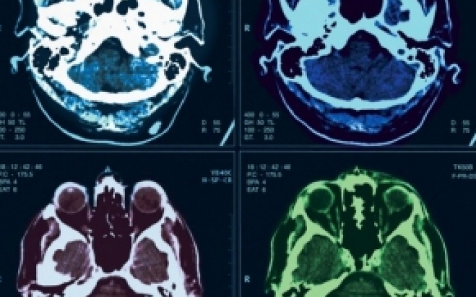 Hematomul epidural - simptome, diagnostic si tratament