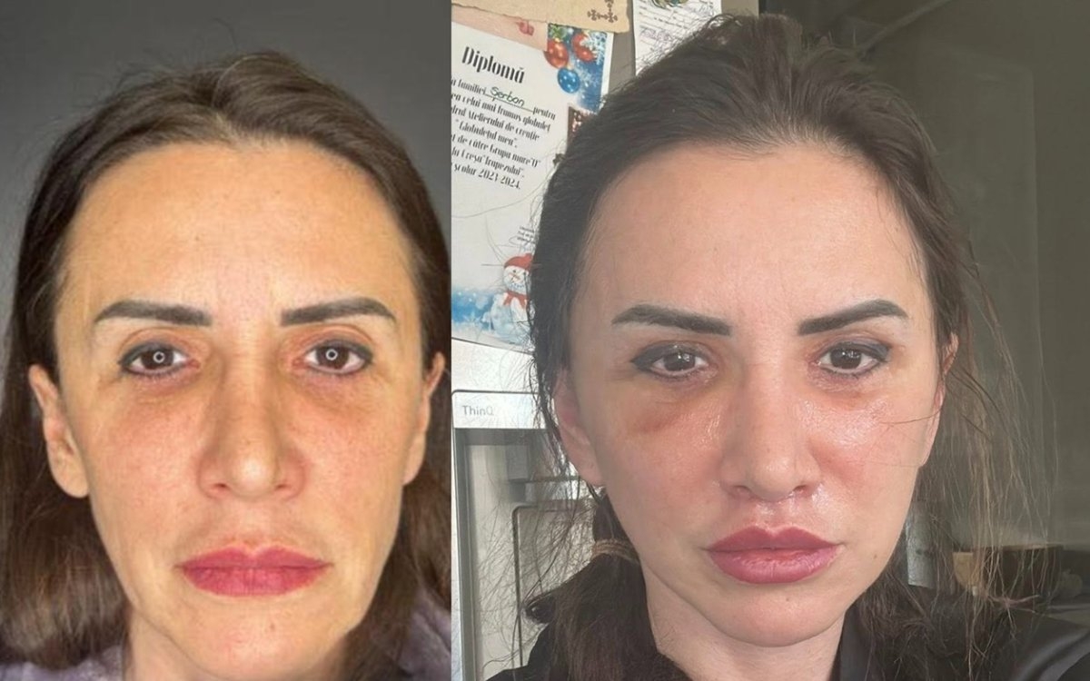 Mara Bănică, mesaj tranșant pentru femeile care o judecă pentru decizia de a face lifting facial: „De asta nu puteți dormi noaptea?”