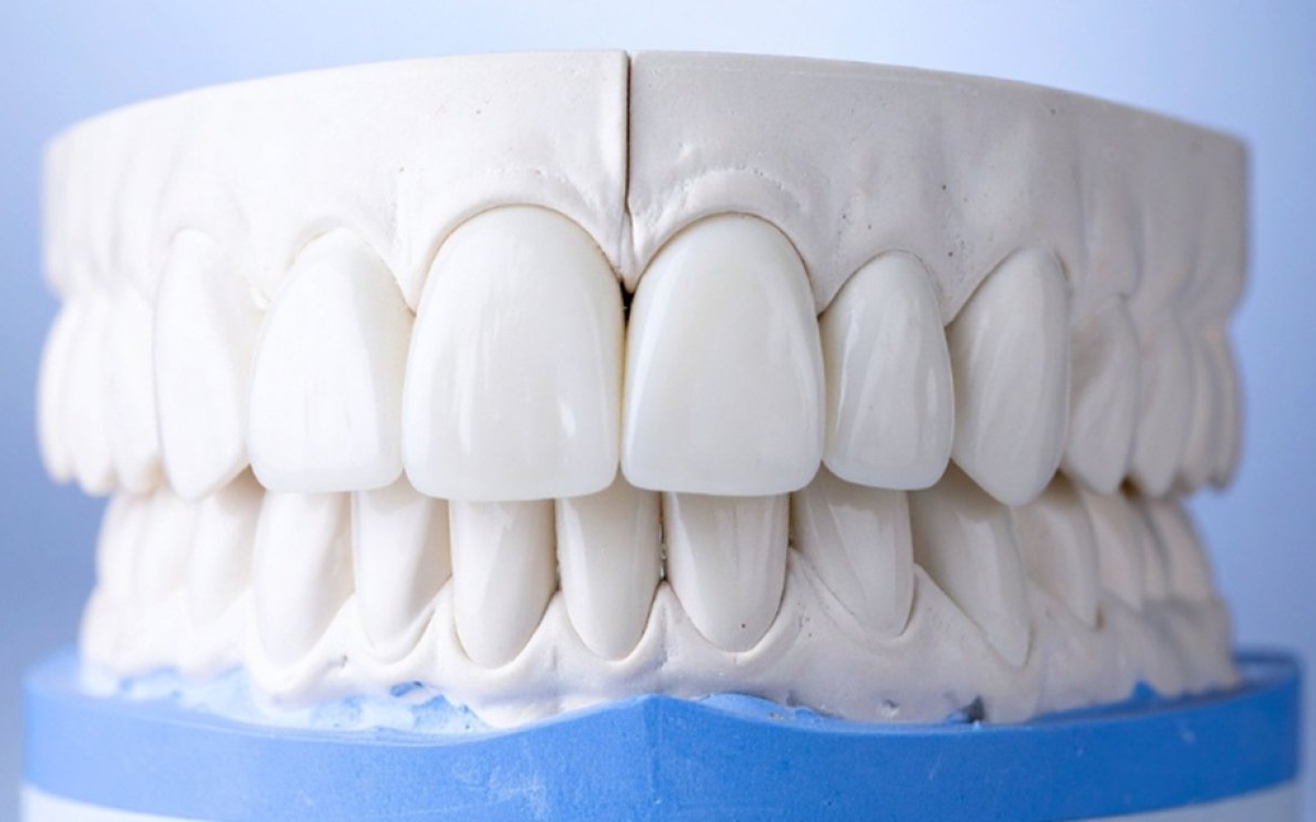 Totul despre fațete dentare. Află despre soluțiile disponibile la Dent Priority