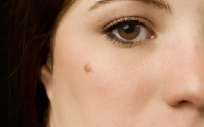 Melanomul- simptome, diagnostic si tratament