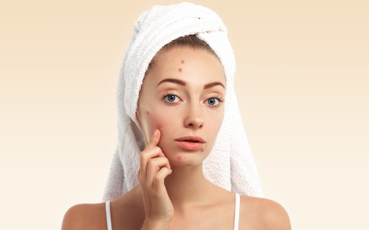 Tenul predispus la acnee: cum alegi o rutină de îngrijire eficientă