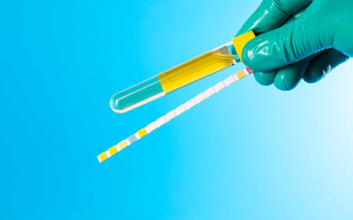 Cristale amorfe în urină: ce înseamnă și de ce apar