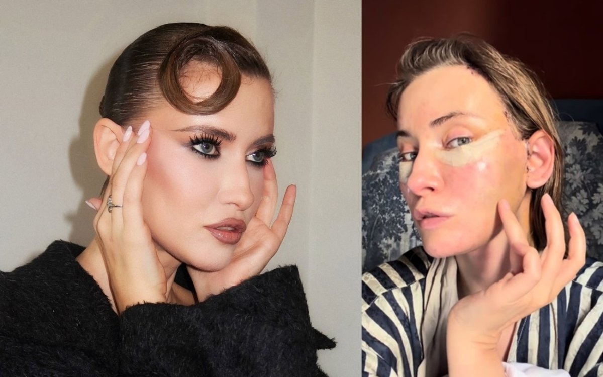 Iulia Albu și-a făcut lifting facial la 44 de ani. Cum arată după operație: „Fără filtre, fără vrăjeală”