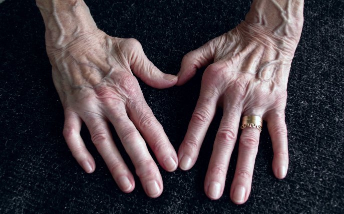 deformarea articulațiilor degetelor în artrita reumatoidă
