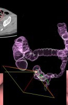 Cancerul colorectal