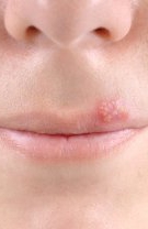 Herpes