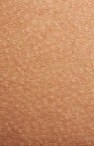 Keratosis pilaris