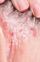 Psoriazis