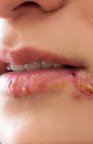 Herpes