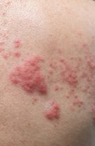 Herpes Zoster