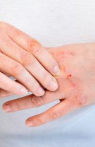 Dermatita (eczema)