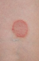 Dermatomicoza