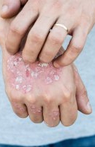 Psoriazis