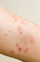 Dermatita de contact