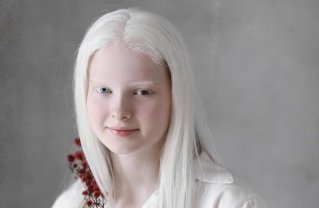 Este diagnosticată cu două afecțiuni genetice rare