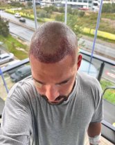 Cum arată Vlad Gherman după cele două implanturi de păr. Cum s-a postat pe rețelele sociale. A trecut printr-o intervenție care a durat 14 ore
