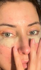 Iulia Albu și-a făcut lifting facial la 44 de ani. Cum arată după operație: „Fără filtre, fără vrăjeală”. S-a pozat cu fața vânătă