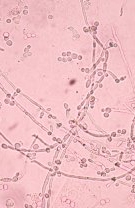 Infecție cu ciuperci de tipul candida