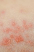 Infecții
