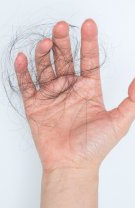 Chelire (alopecia areată)