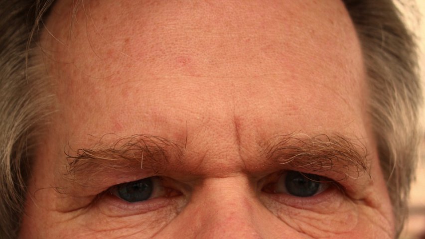 Ridurile de pe frunte și ateroscleroza