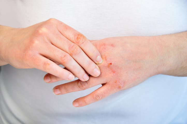 Dermatita (eczema)