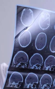 Medicamentul care încetinește boala Alzheimer a fost etichetat ca fiind „istoric”