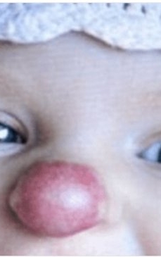 Cum arată astăzi fetița cu 'nasul lui Rudolf', născută cu hemangiom. Este adolescentă și a scăpat de complexele din copilărie